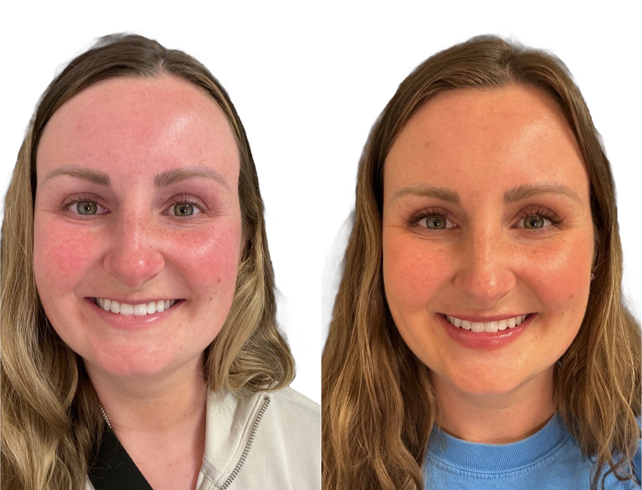 Silk Aesthetics Treatment